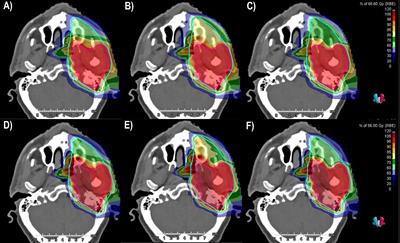 In Silico Feasibility Study of Carbon Ion Radiotherapy With Simultaneous Integrated Boost for Head and Neck Adenoid Cystic Carcinoma